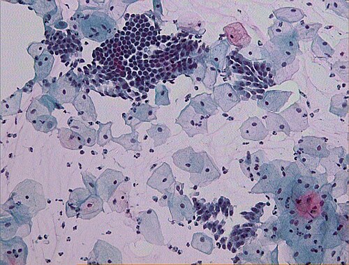 Pap test (Papanicolaou stain): normal cervical cytology